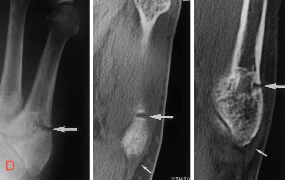 Figure 7 for case Fifth metatarsal base injuries